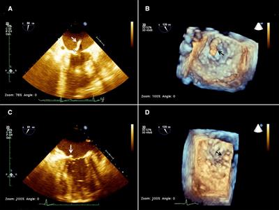 Case report: Treatment of left-sided valve endocarditis using the Transapical AngioVac System and cerebral embolism protection device: A case series